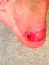 Left Blister.webp