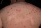 Bed-Bug-Bites.webp