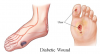 diabetic foot ulcer.png